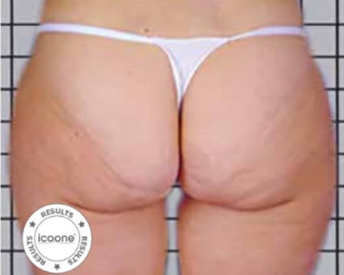 ICOONE Body Contouring – nachher, 53 Jahre