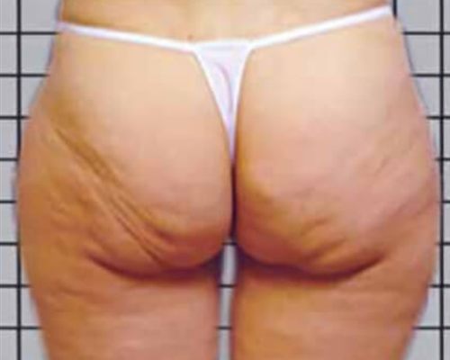 ICOONE Body Contouring – vorher, 53 Jahre