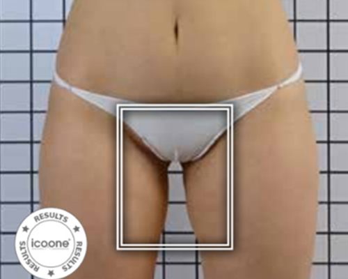 ICOONE Body Contouring – nachher, 30 Jahre