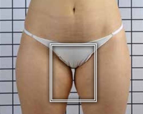 ICOONE Body Contouring – vorher, 30 Jahre