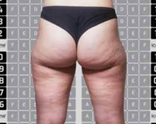 ICOONE Body Contouring – vorher, 20 Jahre