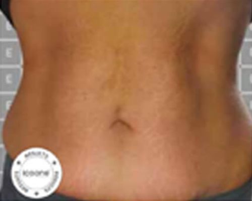 ICOONE Body Contouring – nachher, 40 Jahre