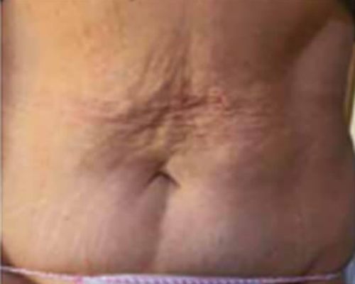 ICOONE Body Contouring – vorher, 40 Jahre